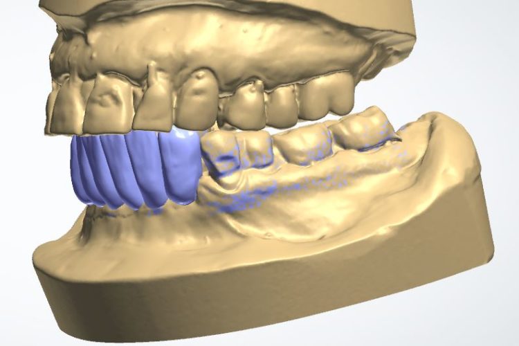 Progetti implantari software guidati