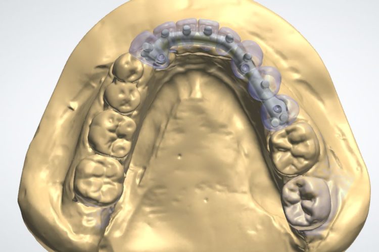 Progetti implantari software guidati