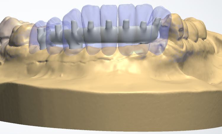Progetti implantari software guidati