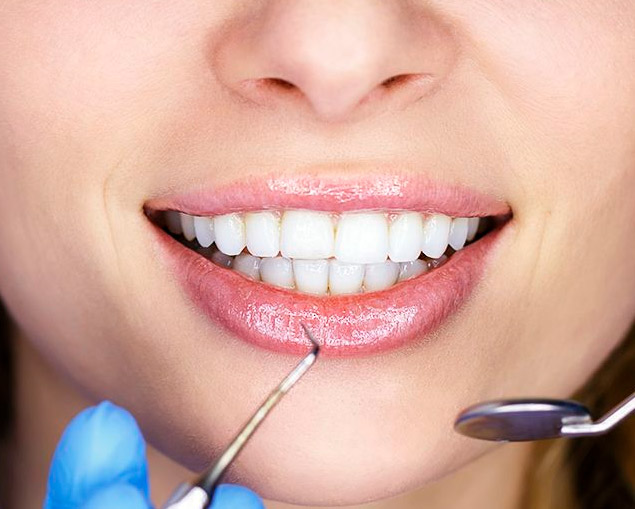 Sbiancamento dentale Studio Dentistico Dr Nicola Barbitta Palermo